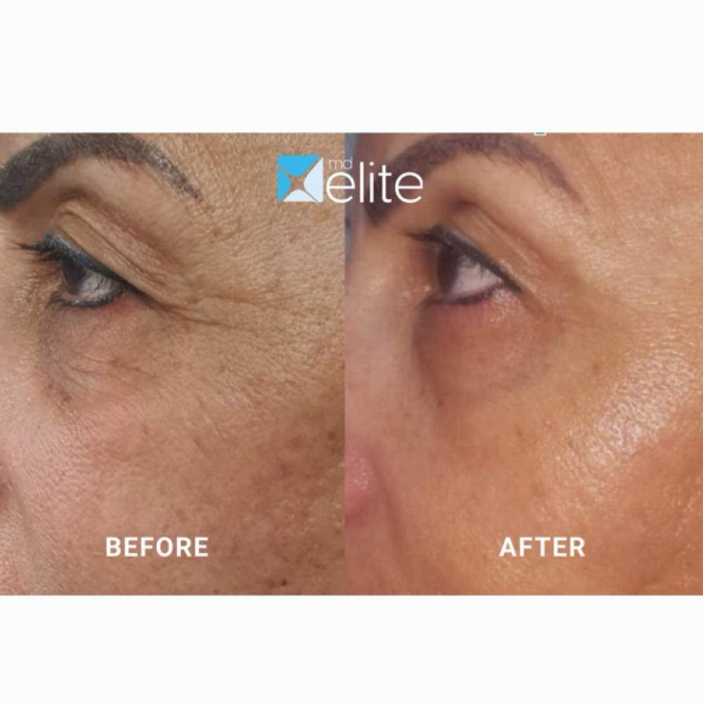 OcuLift at PRYSM LIGHT in West Burlington, IA