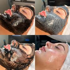 Clarifying Acne Facial at The Beauty Room in Round Lake Beach, IL