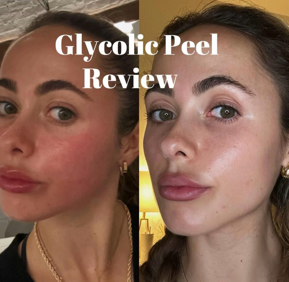 Glycolic Peel Series.