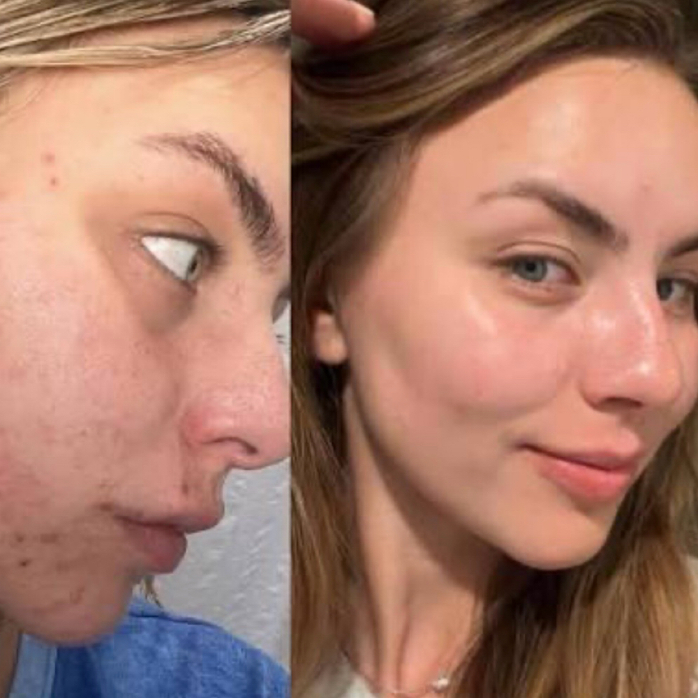 Glycolic Peel Series. at Advanced Micro Aesthetics in Las Vegas, NV