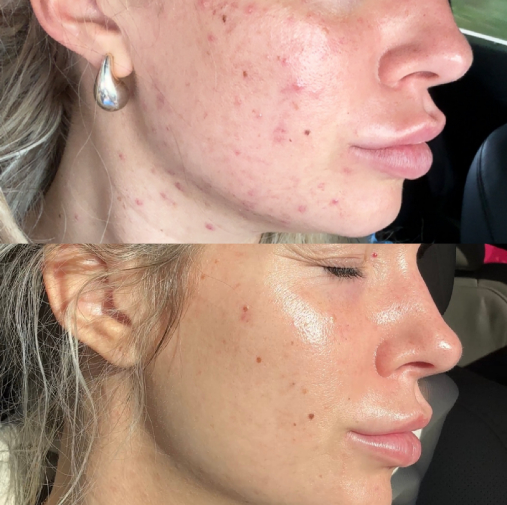 Acne Consultation at Aesthetics by Taryn in Grand Rapids, MI