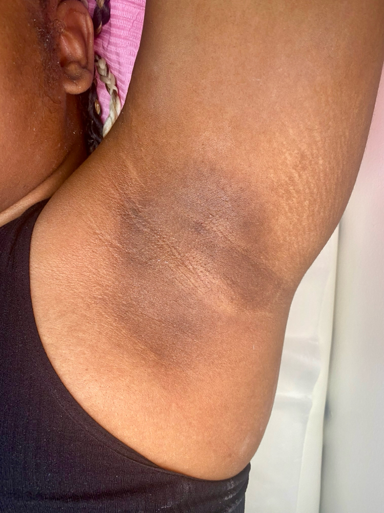 Underarm