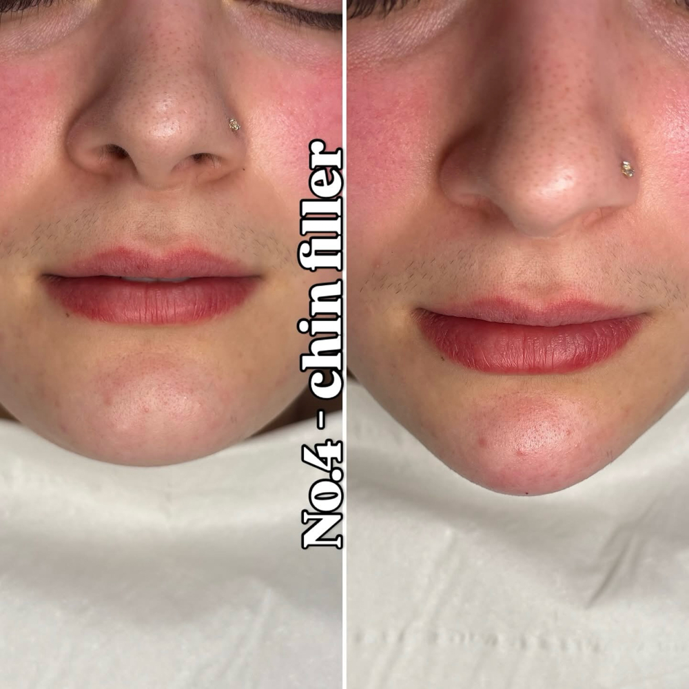 Chin Filler at Lc Beauty Vault in Sinton, TX