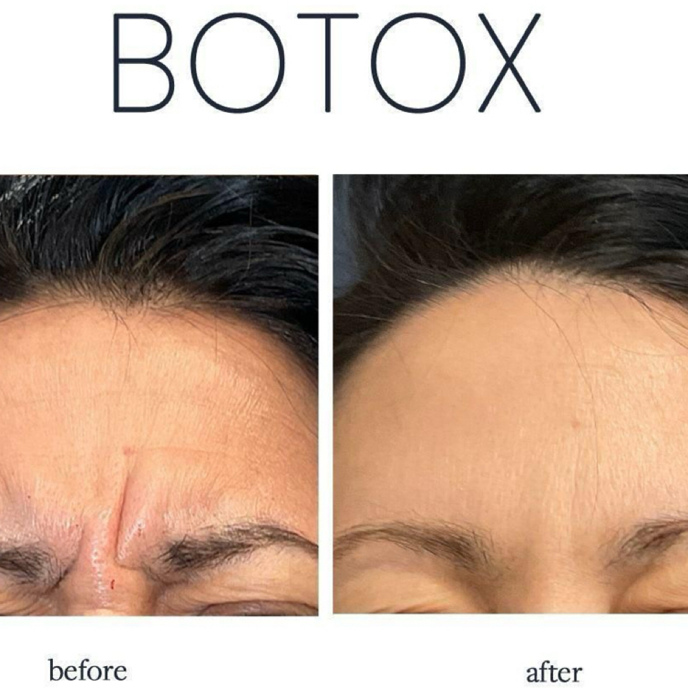 Botox-  Glabellar Lines Only at Groomsology MedSpa in Mt Orab, OH
