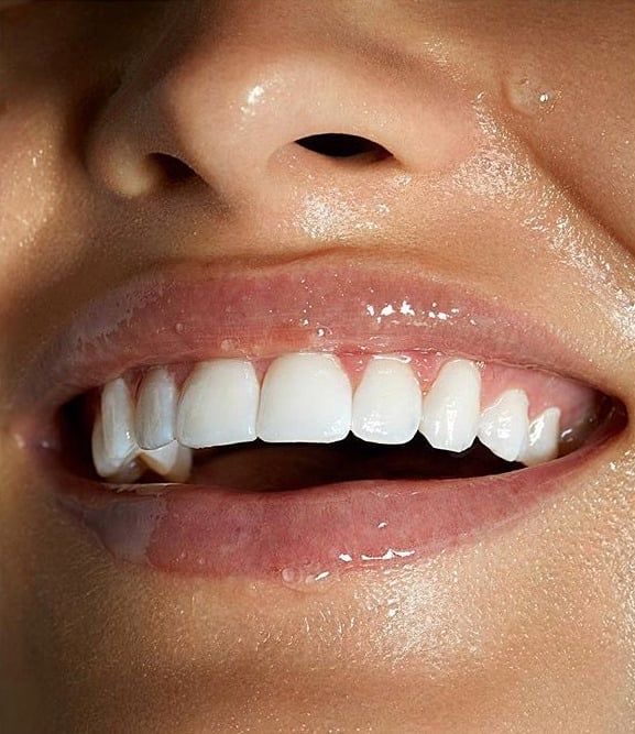 b. radiant (Teeth Whitening)