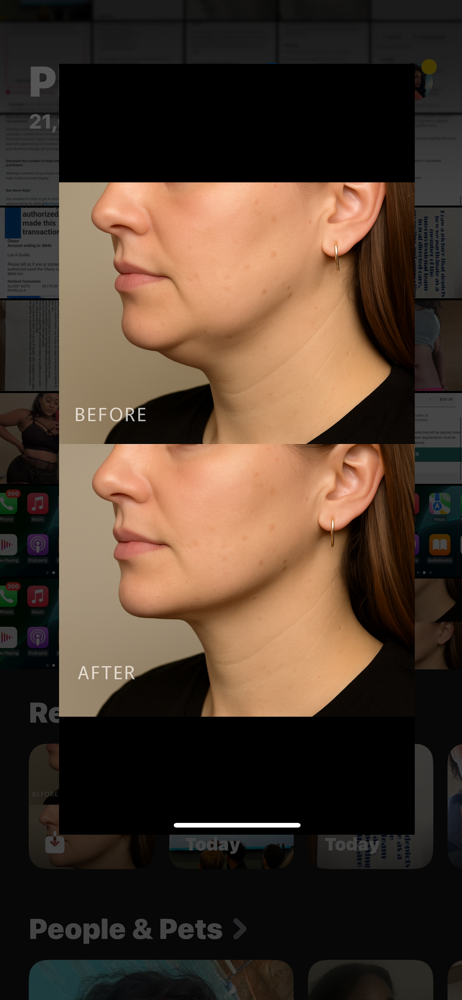Liquid Lipo—Starter Chin Slim