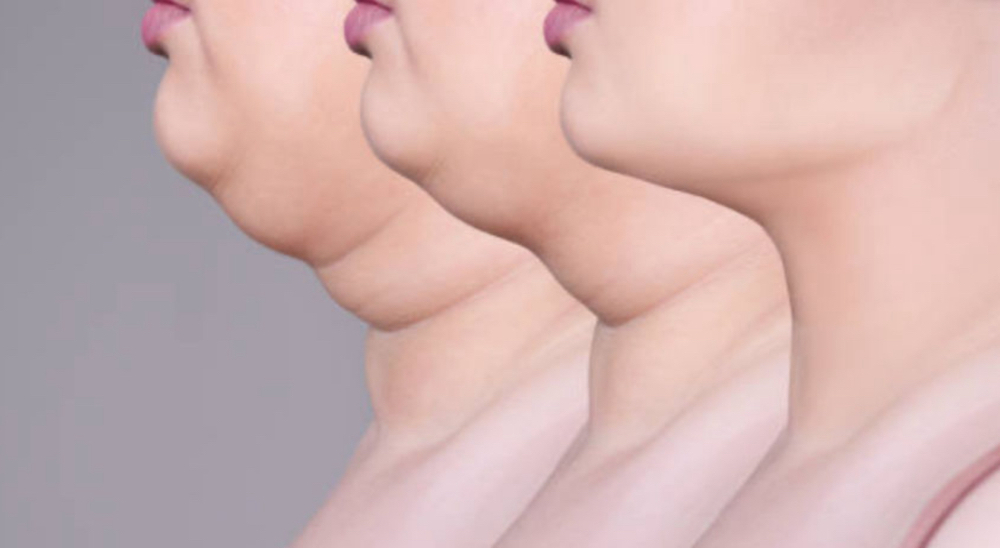 Double Chin Treatment
