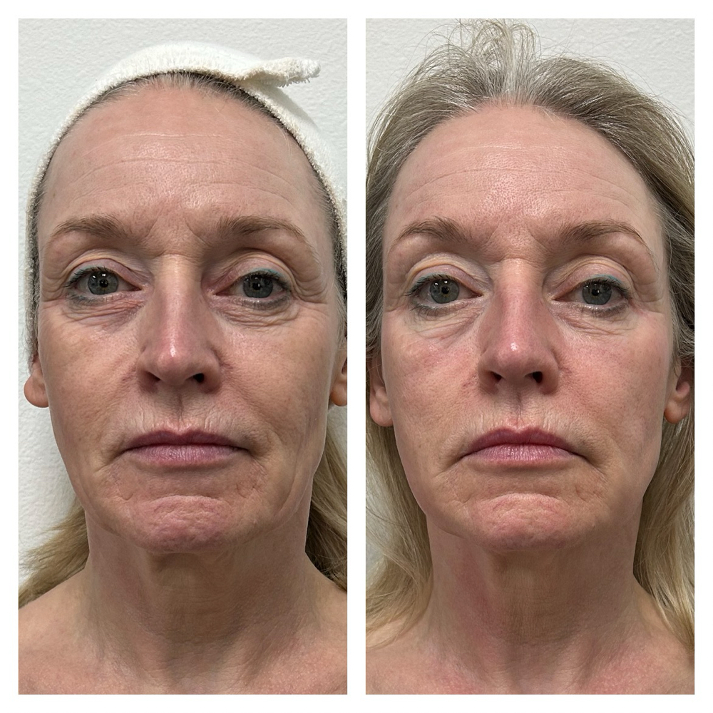 Fascia Firming Treatment