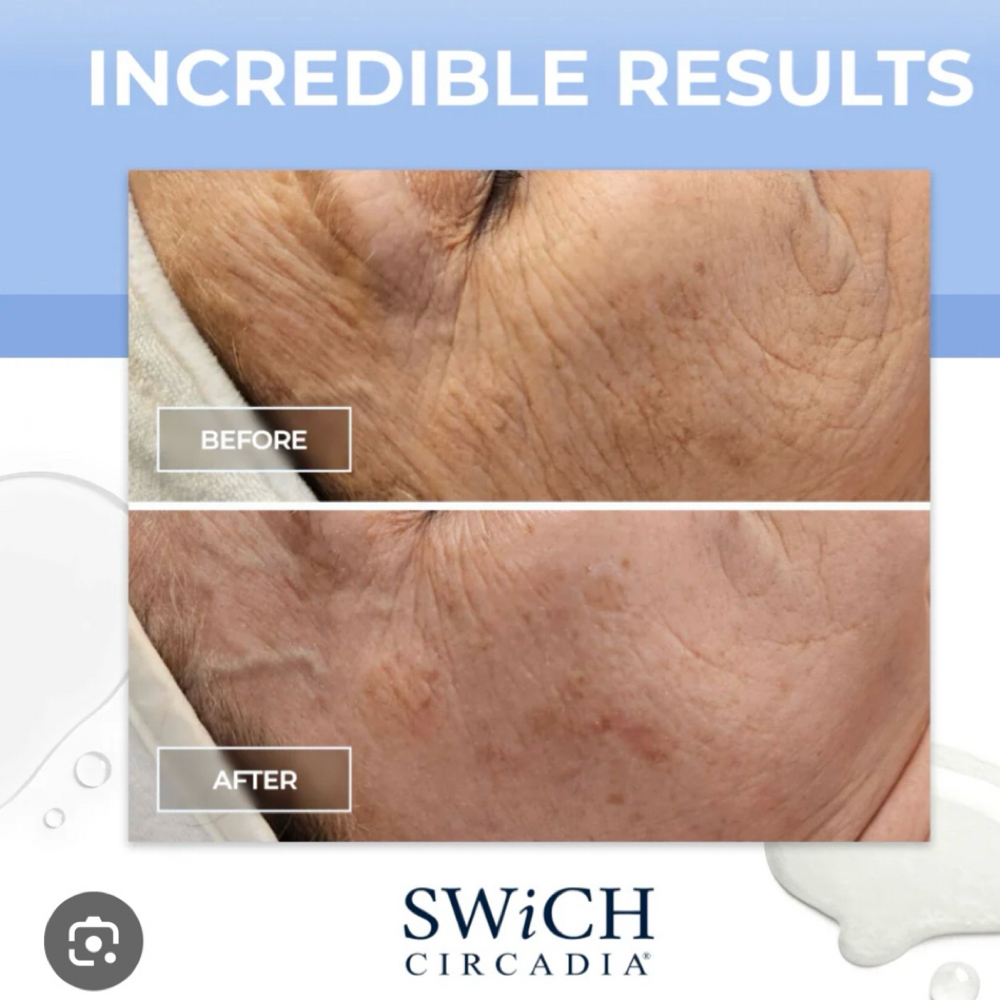 SWiCH at K.Maher Esthetics in Reading, MA