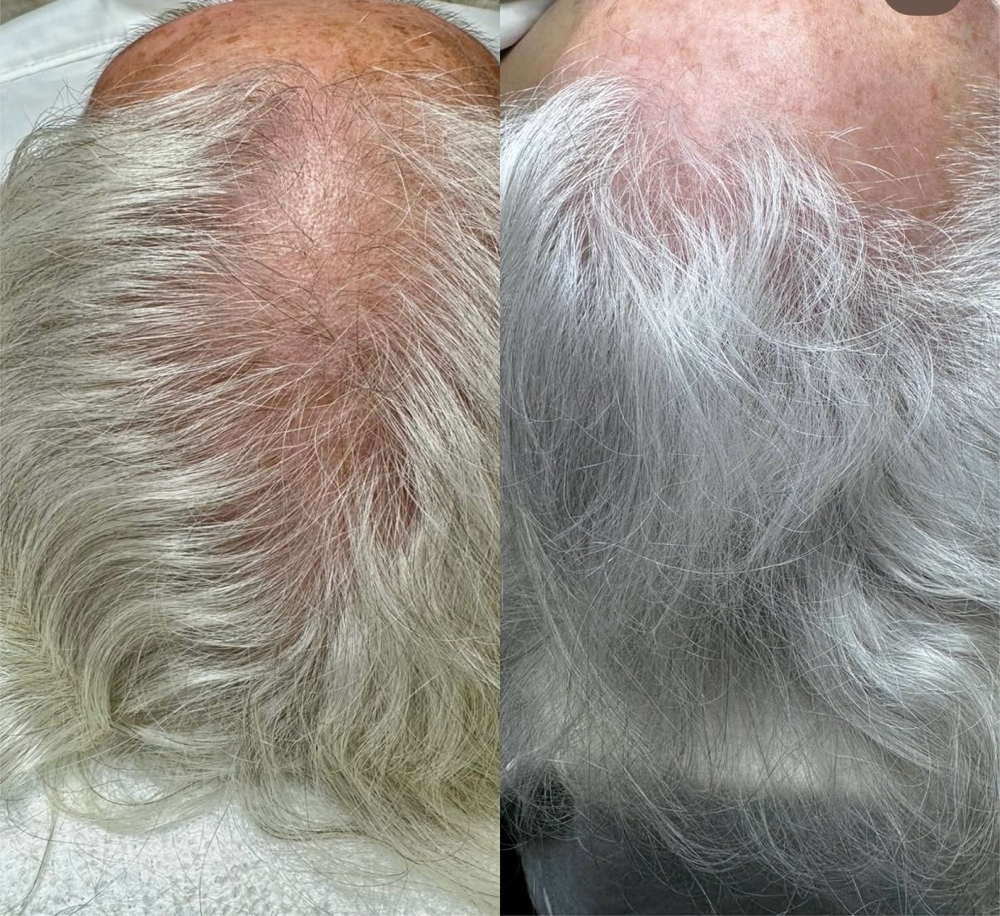 Jet Plasma Hair Restoration at The Wax Room in Midlothian, VA