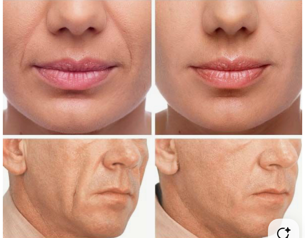 Nasal Fold & marionette Line Filler