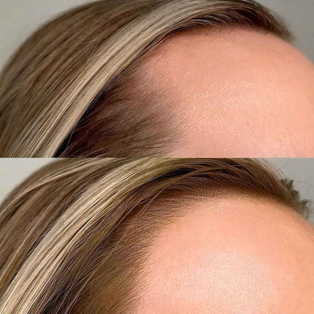 Hairline: 6-8 Week Touch Up at Artistry by Shayla in 13212