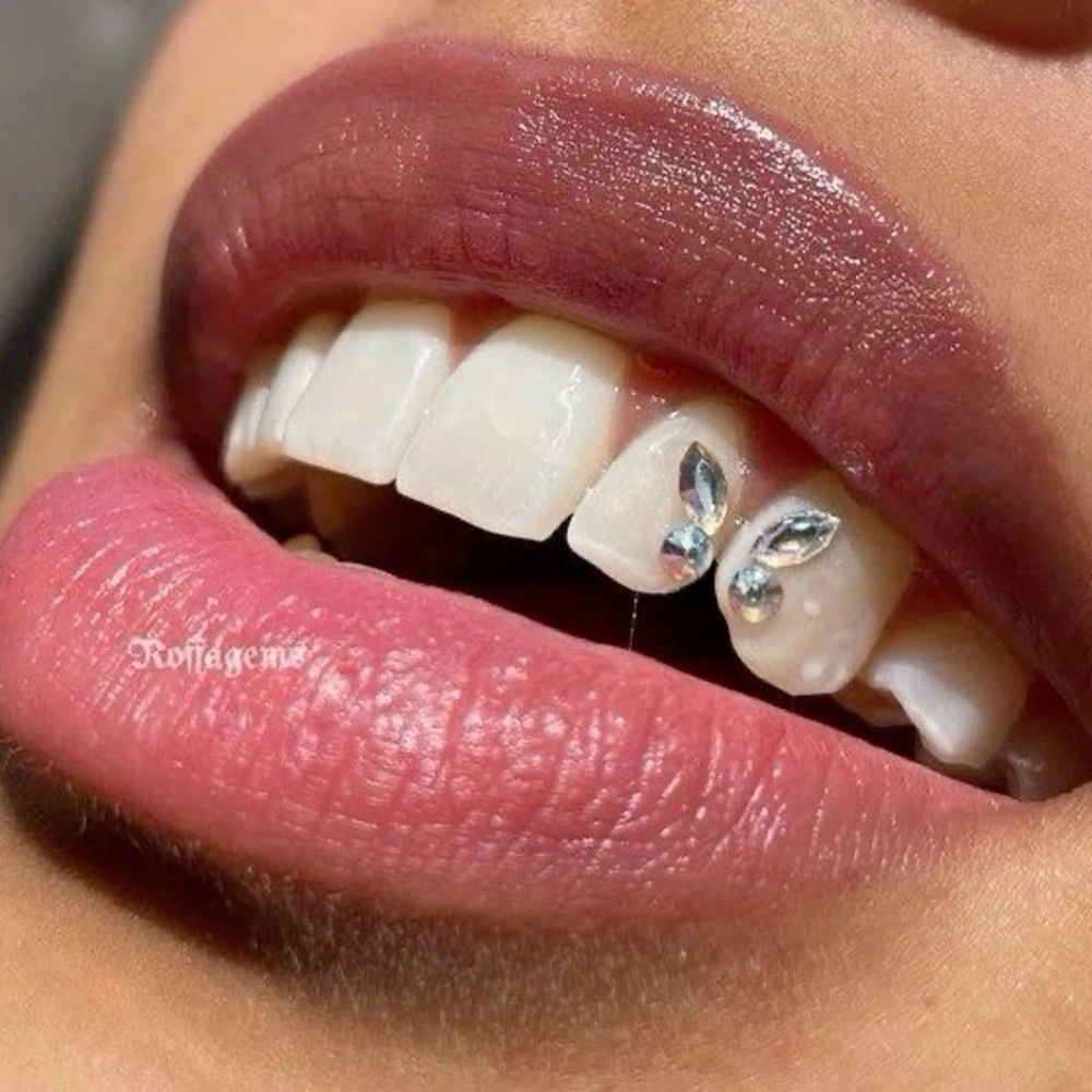 Butterfly Design at The Dental Whitening Studio in Paradise Valley, AZ