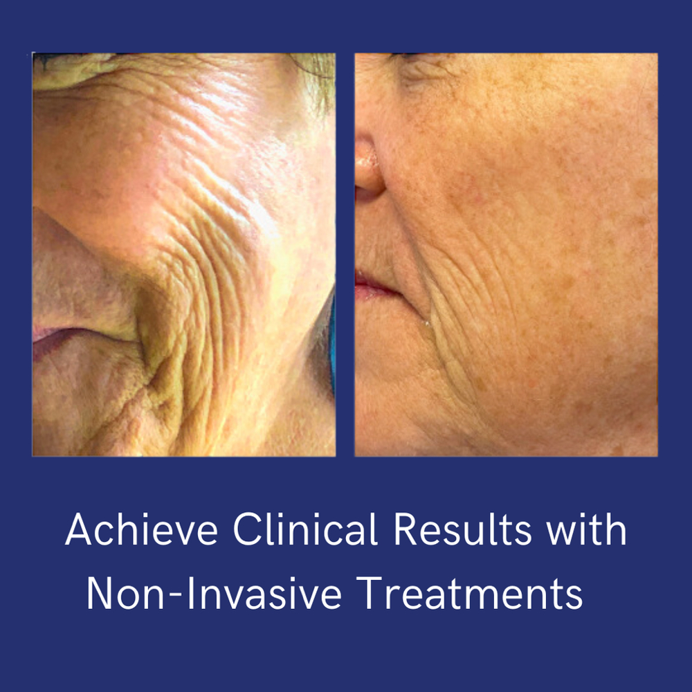 Tone, Lift & Regenerate Therapy at Esthetics By Cindy in Naples, FL