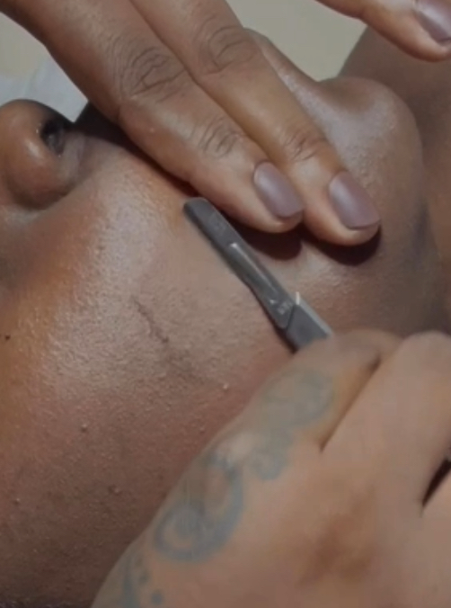 Dermaplane - Add On