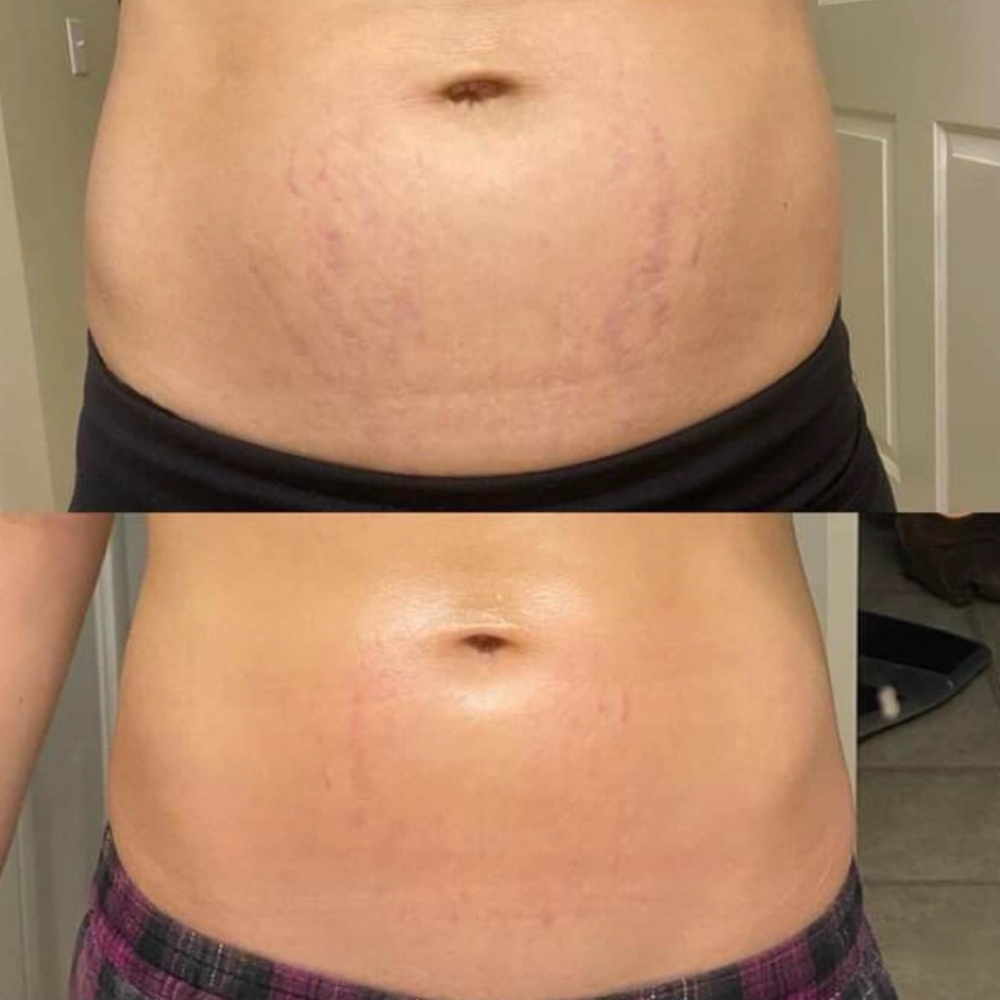 3 Sessions Of ISR at Balance.Bar.Aesthetics in Vallejo, CA