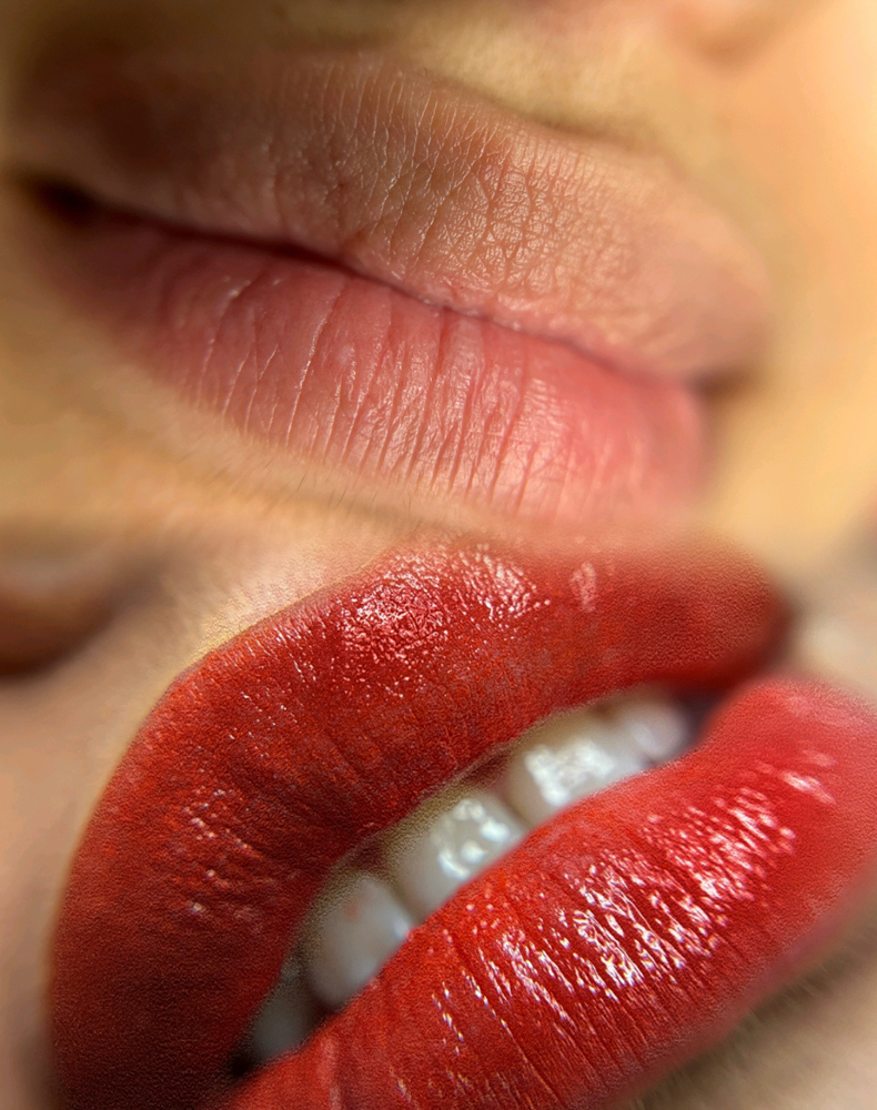 Lip Retouch 1-6 Month Later