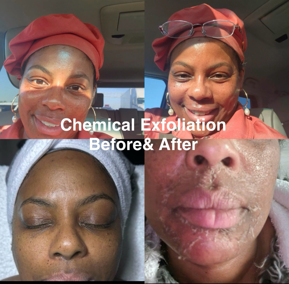Chemical Exfoliation