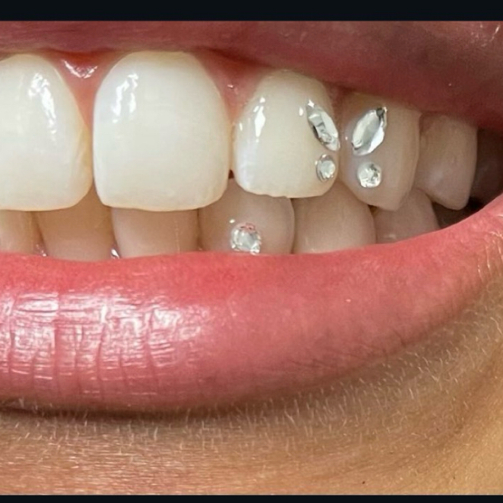 Tooth Gems at Allure Teeth Whitening in Greensboro, NC