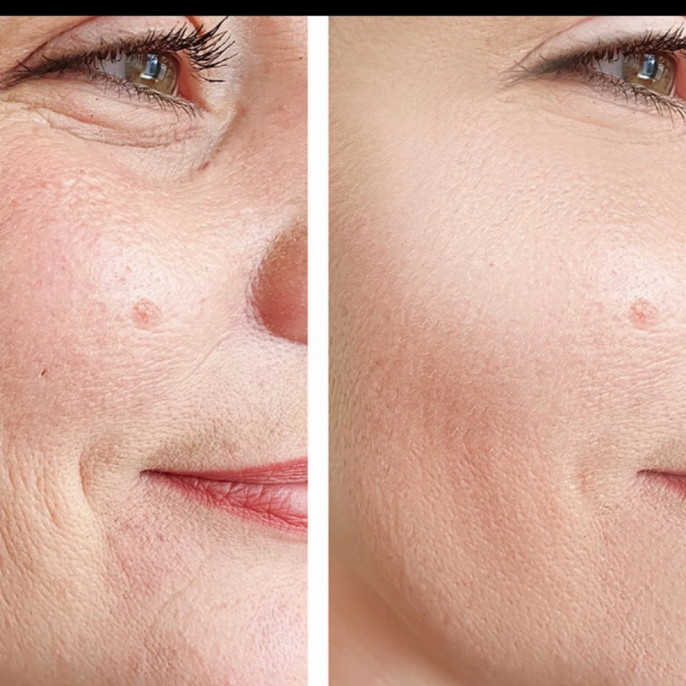 Skin Vive By Juvederm 🩷 at Endless Beauty Aesthetics in El Paso, TX