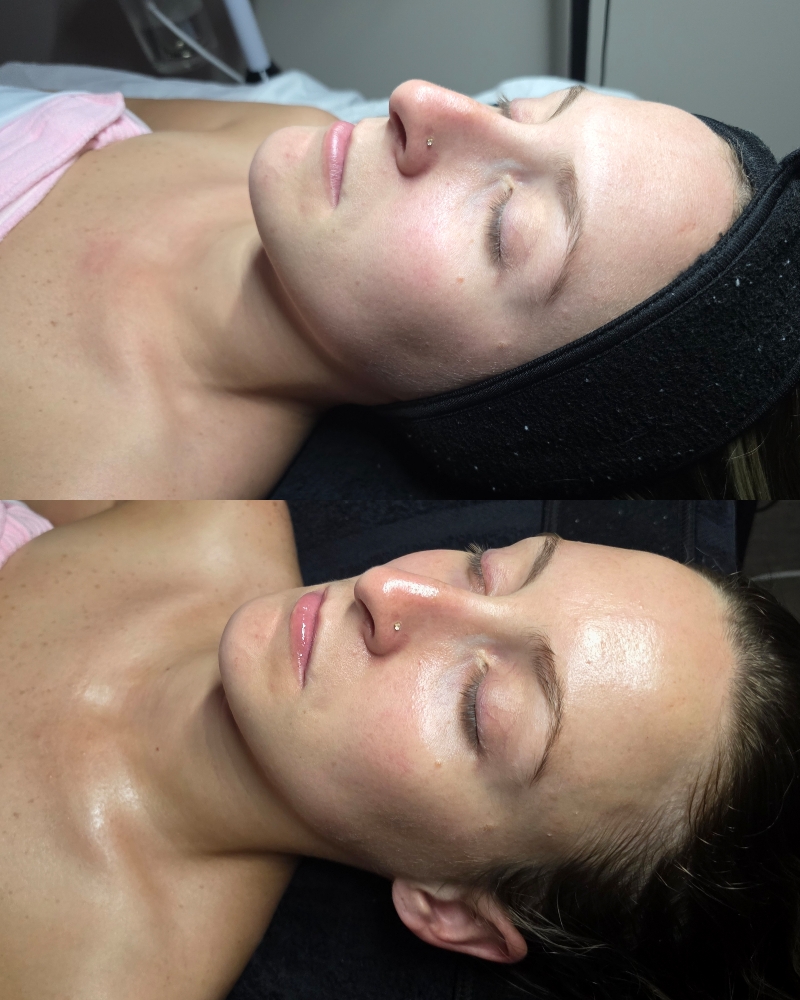 Dermeluxx Diamond Hydrofacial