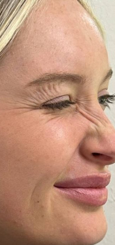 Botox Bunny Lines