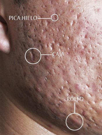 Seculeas de acne