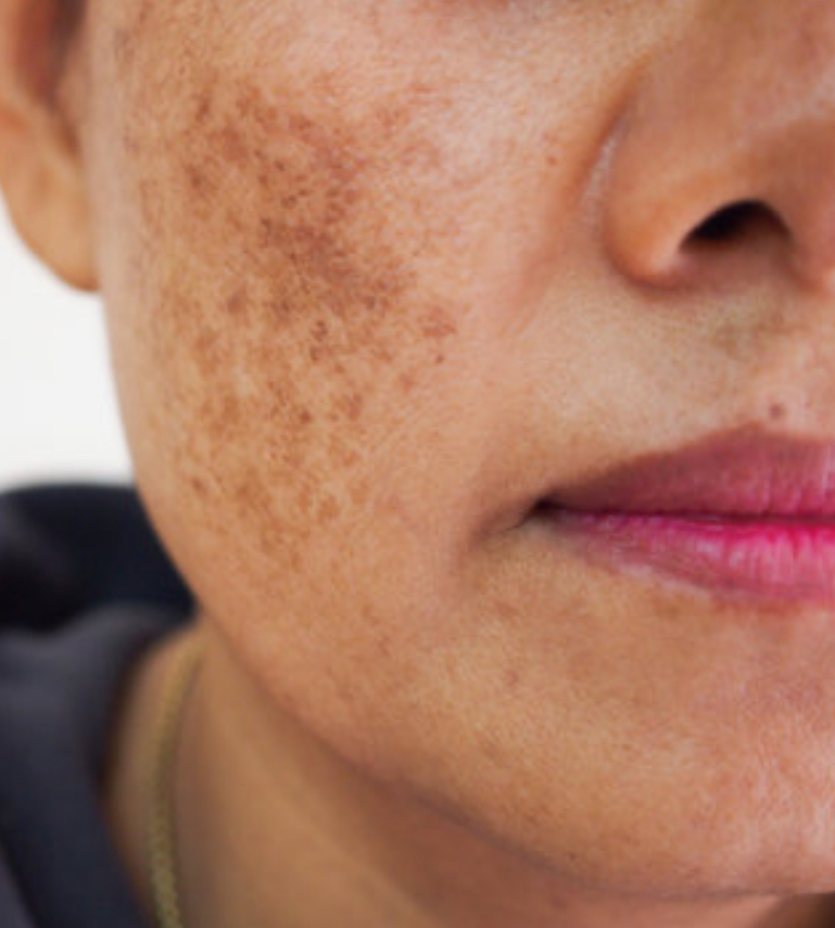 Pigment Peel Plus at Signature Skin Spa in Scottsdale, AZ