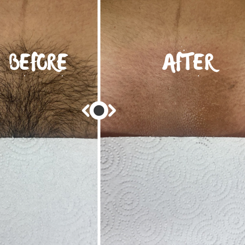 Bikini Frontal Wax at Secret Garden Waxing in Watauga, TX