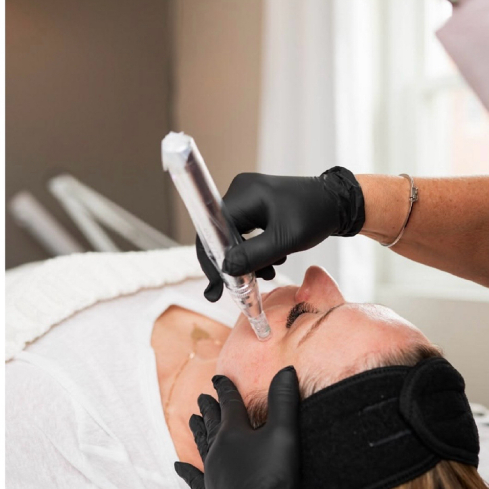 Microneedling Face at Glow & Behold in Durham, NC