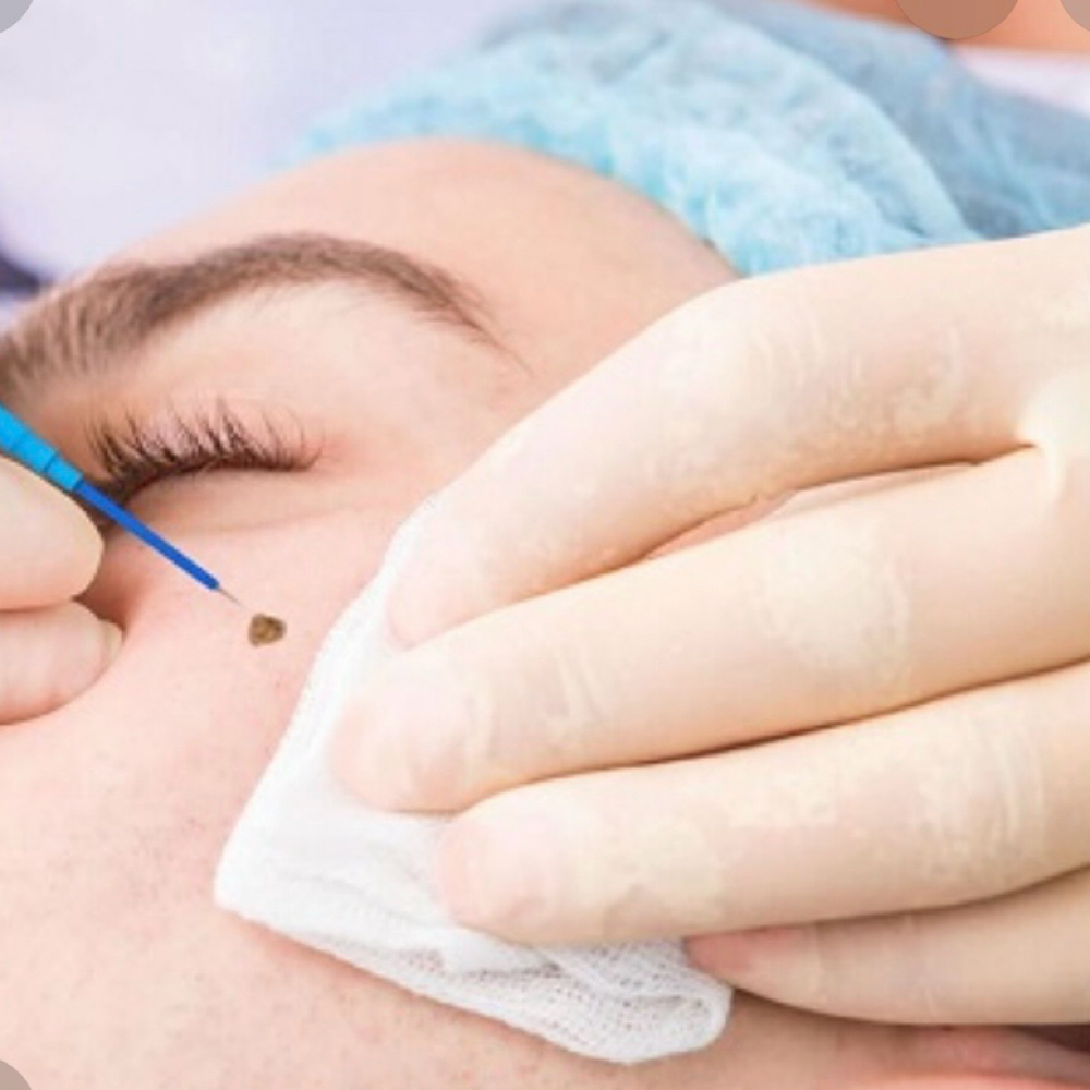 Skin Tag at Luvlookbeautyspa @GlossGenius in Las Vegas, NV