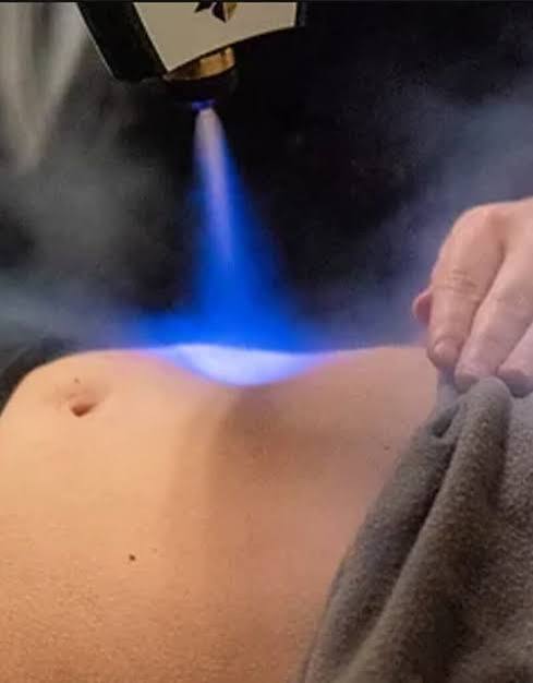 Cryo Skin Tightening