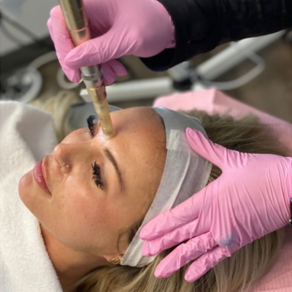 Microneedling with HA pink glow at LM BEAUTY AESTHETICS in Everett, MA