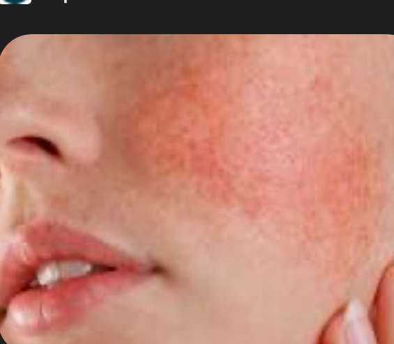 Rosacea Treatment