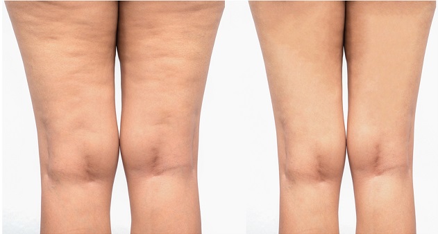 Combo (6) Session (Cavitation + RF)