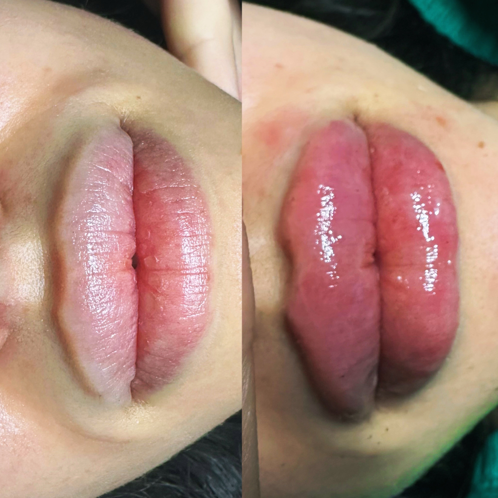 Restylane  Kysse Full