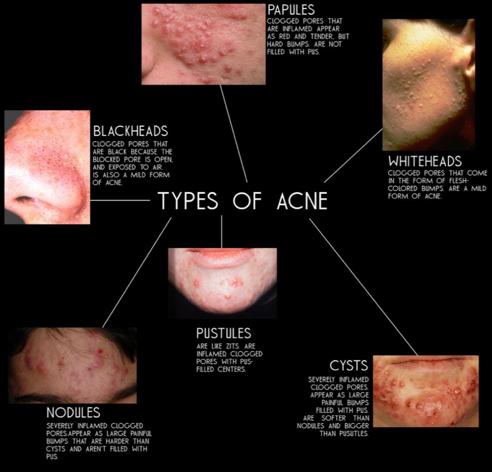Acne Fighter