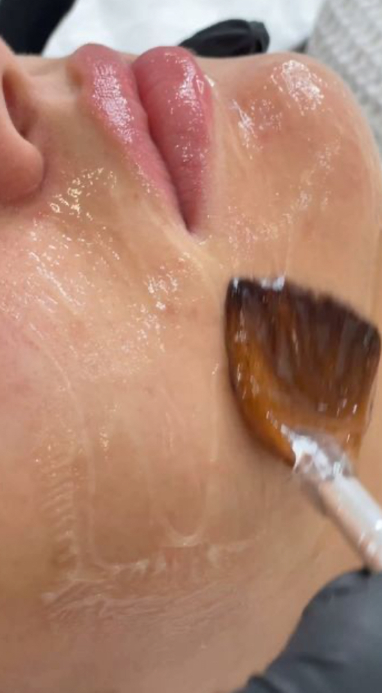 Hydrodermabrasion Facial