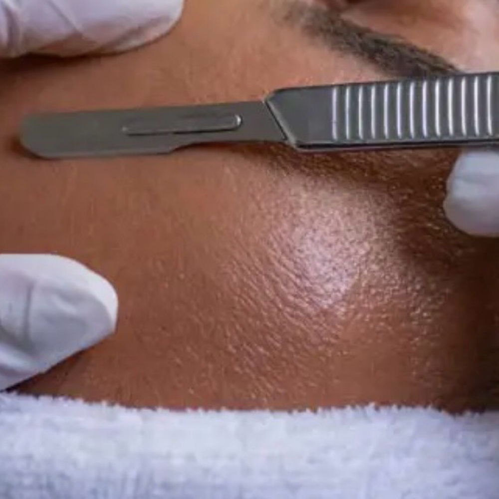 Dermaplaning Add On at Uplift Aesthetics in Union City, TN