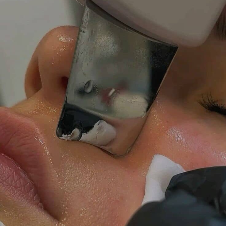 Ultra Sonic Acne Facial Extractions at Glo Up Bar in Saratoga springs, UT