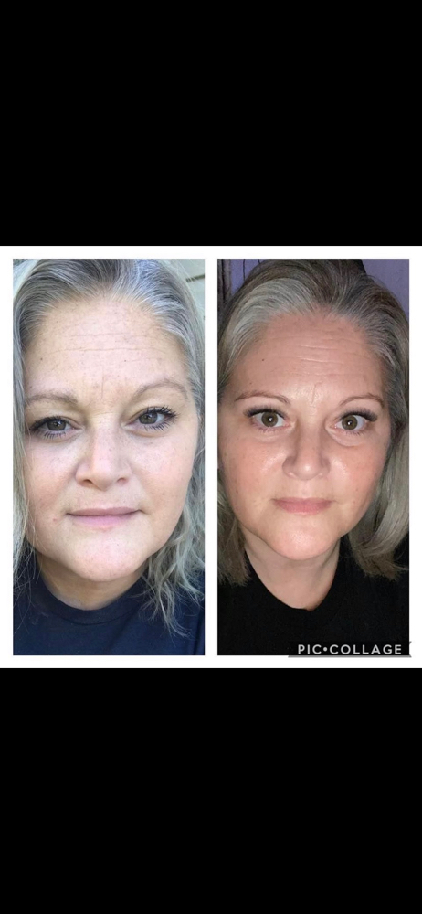 Chemical Peel