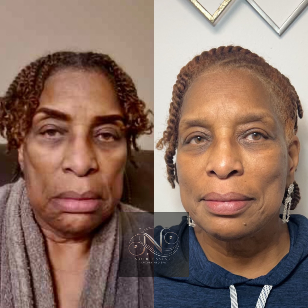 Non-Surgical Face Lift