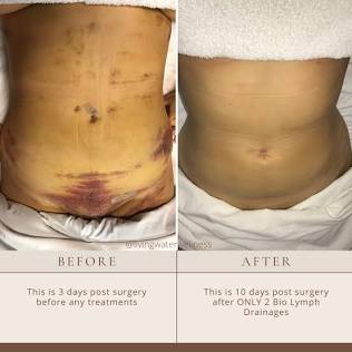 Goddess Recovery(post Op)