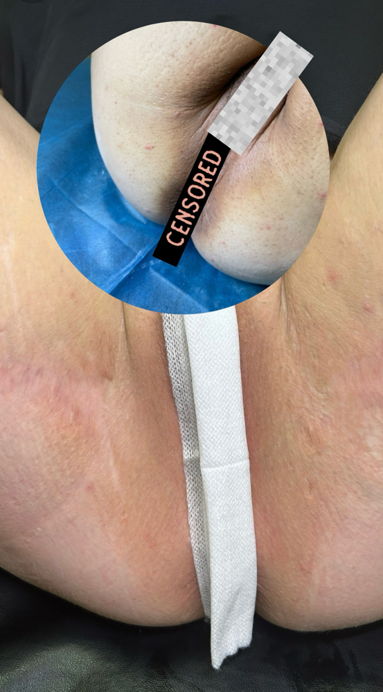 Intimate Bleaching