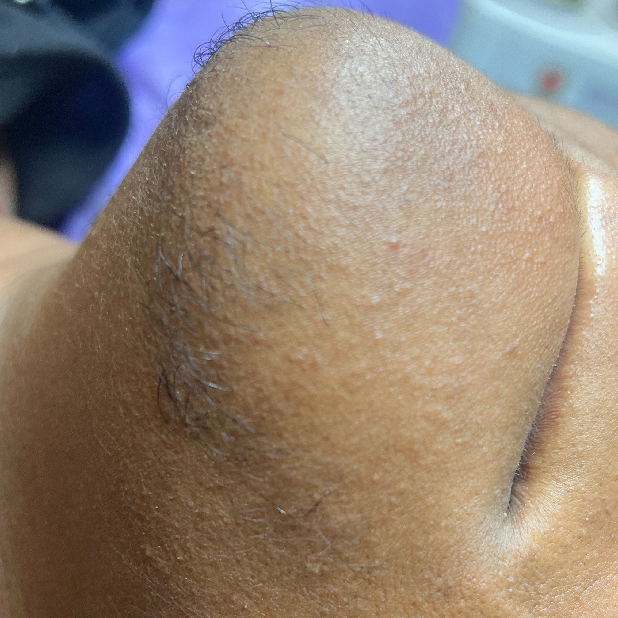 PCOS Intensive Correction Facial at Euphoria 7 Spa in St. Louis, MO