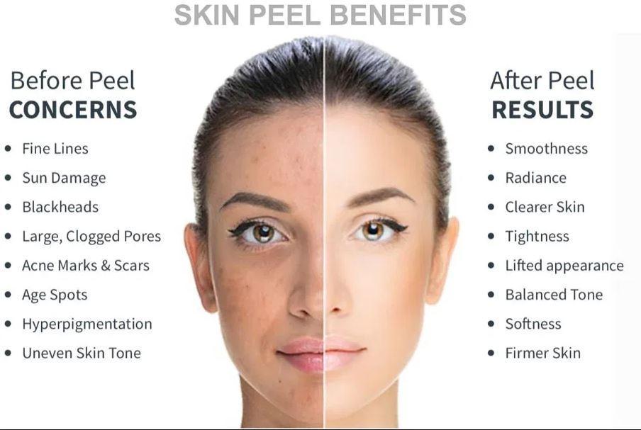 Chemical Peels