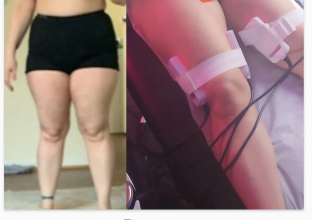 Cellulite One Side 3 Sessions