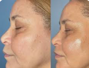HydraFacial Treatment