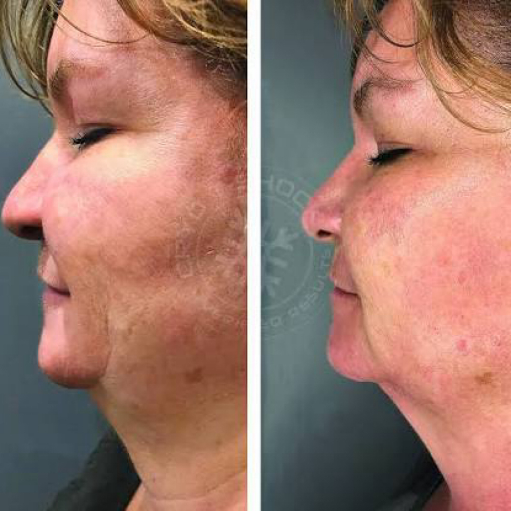 Cryo T-Shock Double Chin