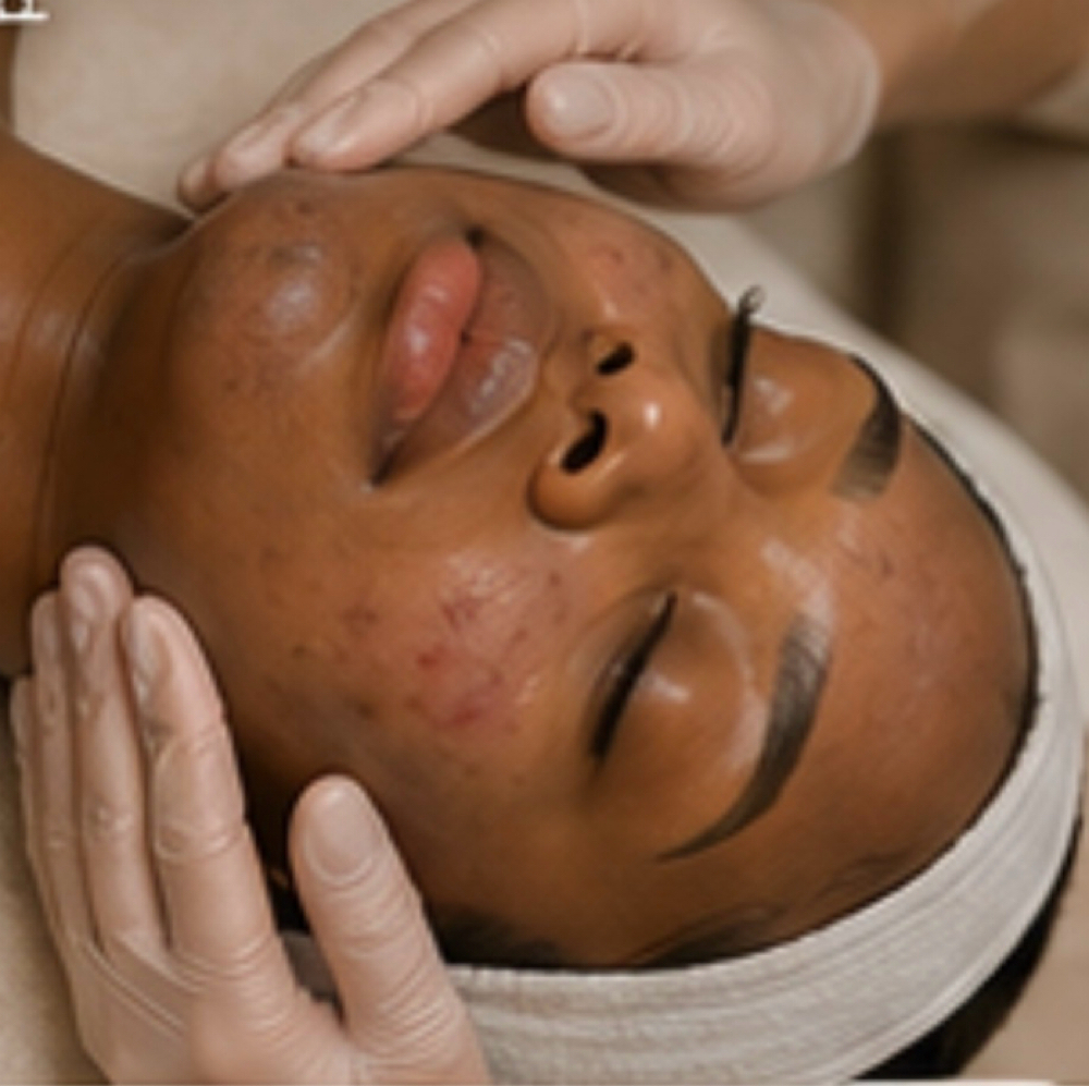 Acne Facial at The Aesthetic Collective in Roseville, MI